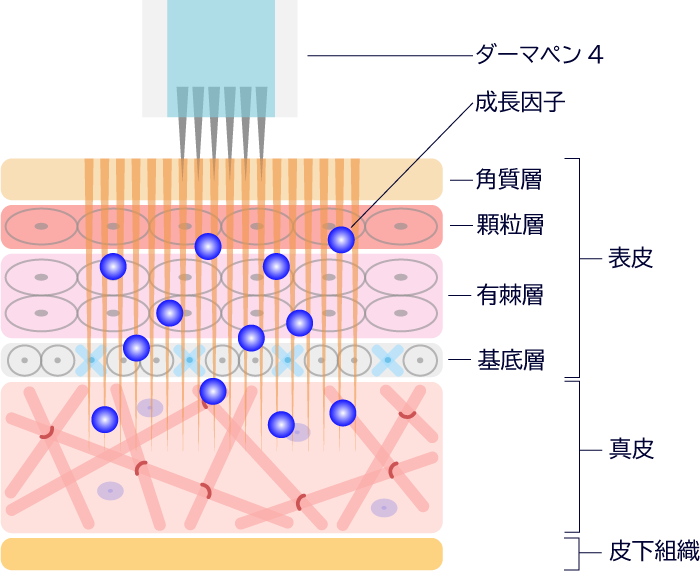 ヴァンパイアフェイシャル